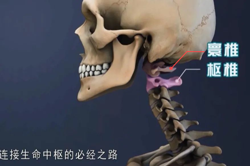 【案例分享】顱底凹陷、寰樞椎脫位，你了解多少？