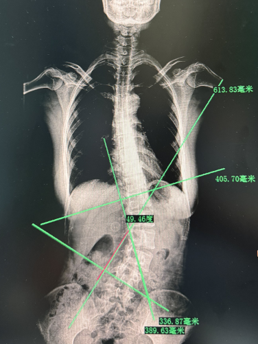 什么！脊柱矯正還能長(zhǎng)高？